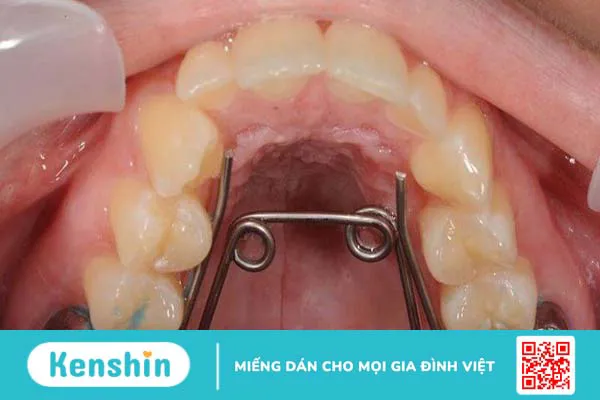 Nong hàm là gì? Khi nào cần thực hiện?