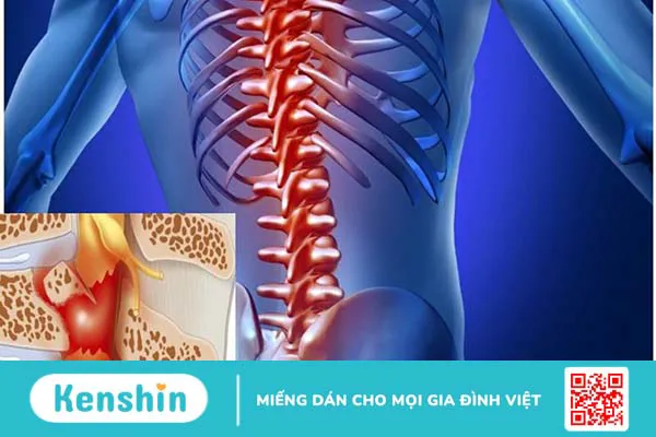 Nóng rát sau lưng có phải dấu hiệu của bệnh không? Nguyên nhân và cách xử lý 2