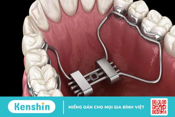 Nong xương là gì? Khi nào cần thực hiện nong xương?