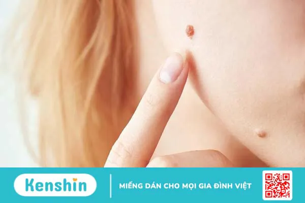 Nốt ruồi bẩm sinh có tẩy được không?