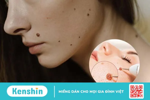 Nốt ruồi bẩm sinh có tẩy được không?