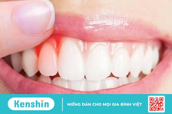 Nướu là gì? Cấu tạo và chức năng của nướu