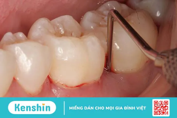 Nướu là gì? Cấu tạo và chức năng của nướu 3