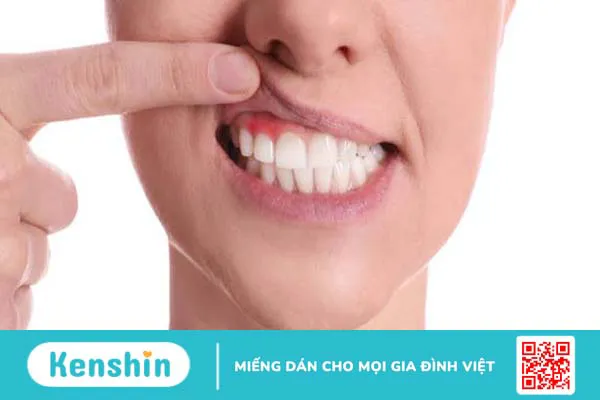 Nướu là gì? Cấu tạo và chức năng của nướu 4