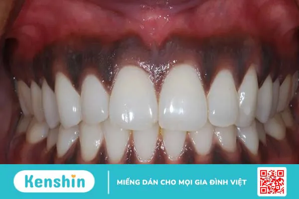 Nướu răng bị đen: Nguyên nhân, triệu chứng và cách điều trị