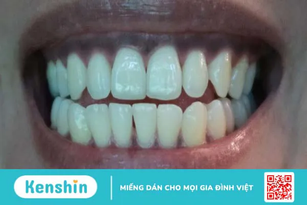 Nướu răng bị đen: Nguyên nhân, triệu chứng và cách điều trị