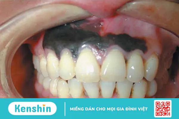 Nướu răng bị đen: Nguyên nhân, triệu chứng và cách điều trị