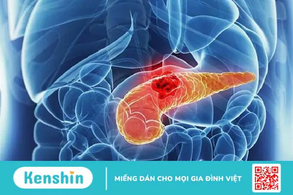 Nút mạch gan: Kỹ thuật điều trị ung thư gan hiệu quả 4