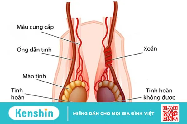 Ống dẫn tinh là gì? Một số thông tin về bệnh tắc ống dẫn tinh bạn cần biết