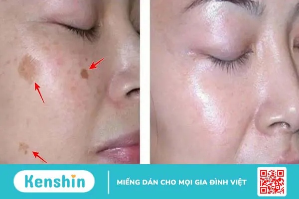 Peel da có trị nám được không?