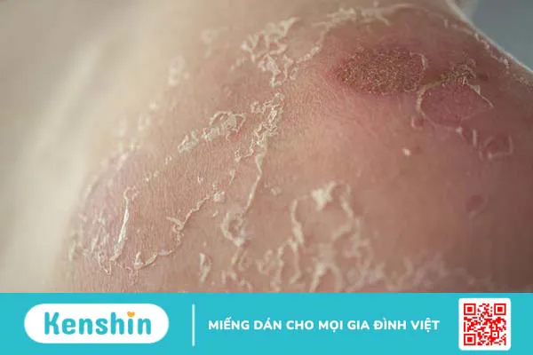 Peel da hoá học: Ưu nhược điểm và 3 cấp độ peel da