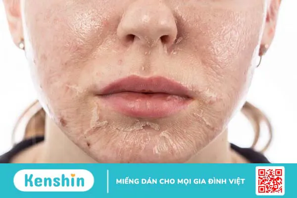 Peel da hoá học: Ưu nhược điểm và 3 cấp độ peel da