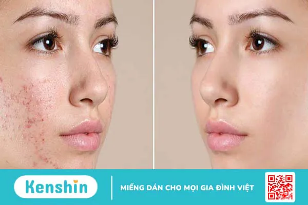 Peel da trị mụn có tốt không? Ưu và nhược điểm của quá trình peel da trị mụn?