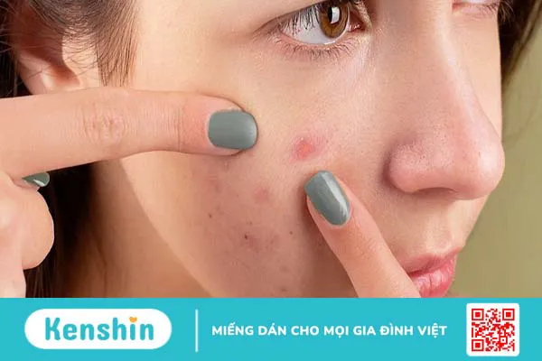 Peel da trị mụn có tốt không? Ưu và nhược điểm của quá trình peel da trị mụn?