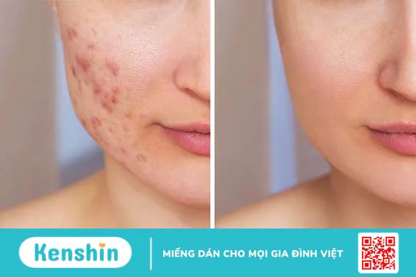 Giải đáp thắc mắc: Peel da vi tảo là gì và có tác dụng gì 1