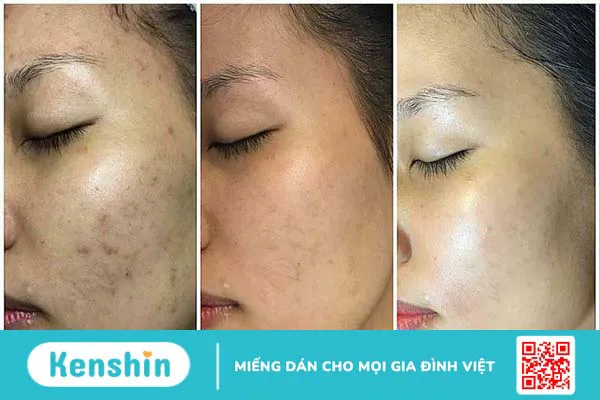 Giải đáp thắc mắc: Peel da vi tảo là gì và có tác dụng gì 2