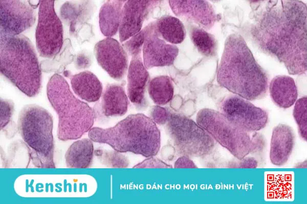 Phác đồ điều trị Mycoplasma: Những điều cần biết để đối phó với bệnh