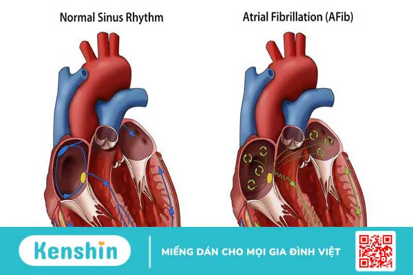 Phác đồ điều trị rung nhĩ như thế nào? Những lưu ý người bệnh cần nắm