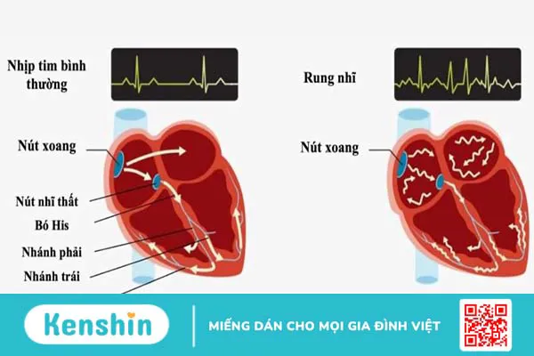 Phác đồ điều trị rung nhĩ như thế nào? Những lưu ý người bệnh cần nắm