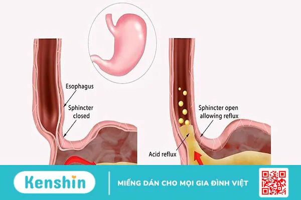 Phân biệt ợ chua, trào ngược axit và GERD như thế nào?