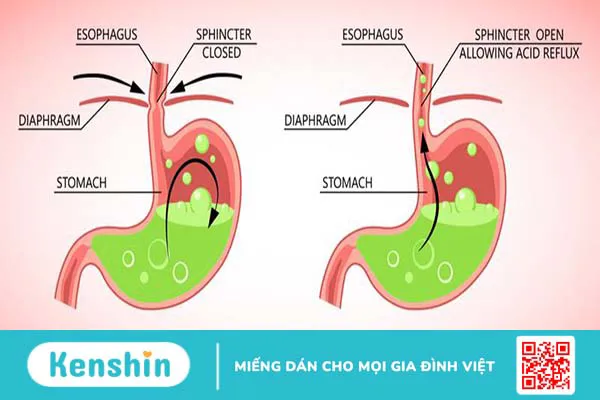 Phân biệt ợ chua, trào ngược axit và GERD như thế nào?