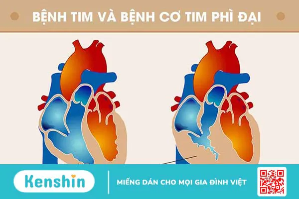 Phẫu thuật điều trị bệnh cơ tim phì đại cho trẻ và những điều cần lưu ý