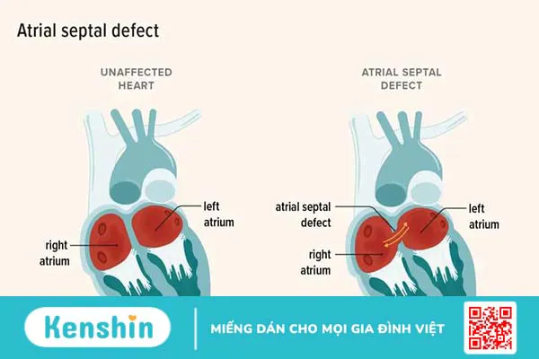 Phẫu thuật đóng lỗ thông liên nhĩ 2