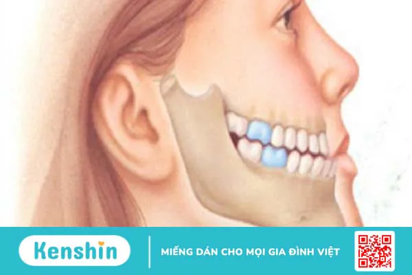 Phẫu thuật hàm móm bao lâu thì lành? Cách chăm sóc cơ thể sau phẫu thuật hàm móm