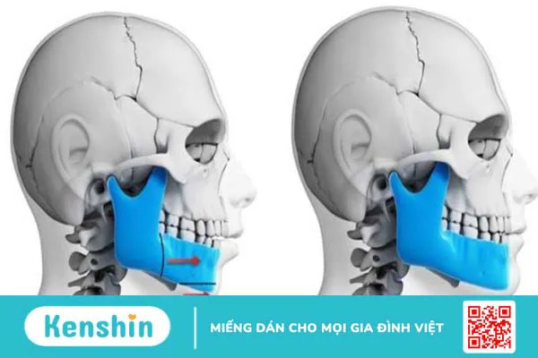 Phẫu thuật hàm móm bao lâu thì lành? Cách chăm sóc cơ thể sau phẫu thuật hàm móm