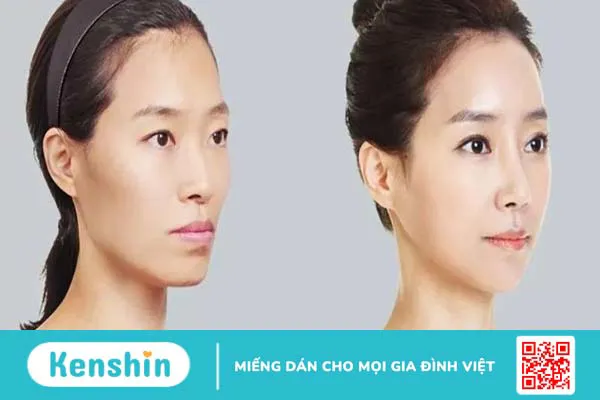 Phẫu thuật miệng cười: Trào lưu thẩm mỹ được ưa chuộng