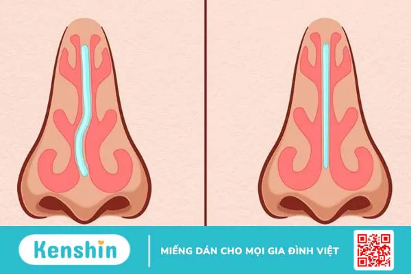 Phẫu thuật vách ngăn mũi giá bao nhiêu? Thời gian hồi phục sau phẫu thuật