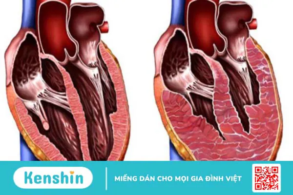 Phì đại thất trái: Nguyên nhâ, triệu chứng, điều trị và phòng ngừa 1