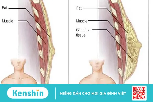 Phì đại tuyến vú ở nam giới là gì? Tiên lượng và điều trị bệnh