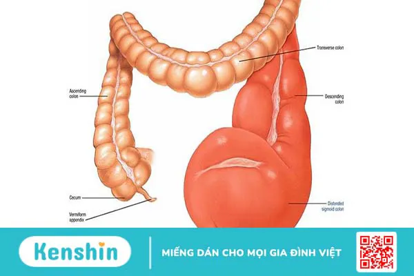 Phình đại tràng: Phương pháp điều trị hiệu quả