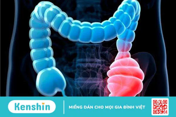 Phình đại tràng: Phương pháp điều trị hiệu quả