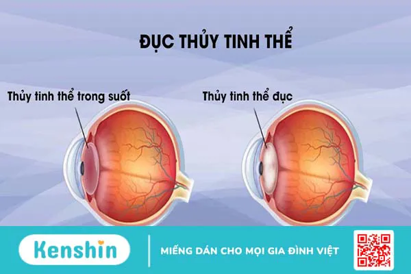 Phòng tránh các bệnh về mắt bằng cách nào để đôi mắt luôn khỏe mạnh?