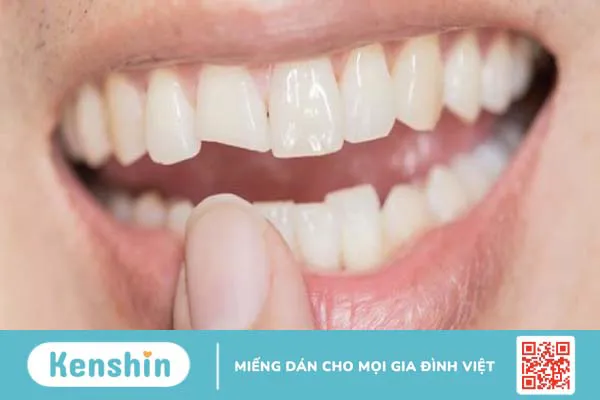 Phục hình răng là gì? Phân loại các phương pháp phục hình răng