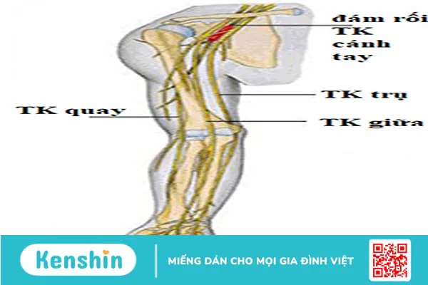 Phục hồi chức năng tổn thương thần kinh giữa