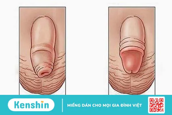 Phương pháp cắt bao quy đầu như thế nào? Lưu ý khi cắt bao quy đầu