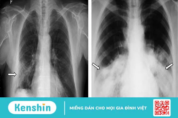 Phương pháp chẩn đoán COPD chính xác