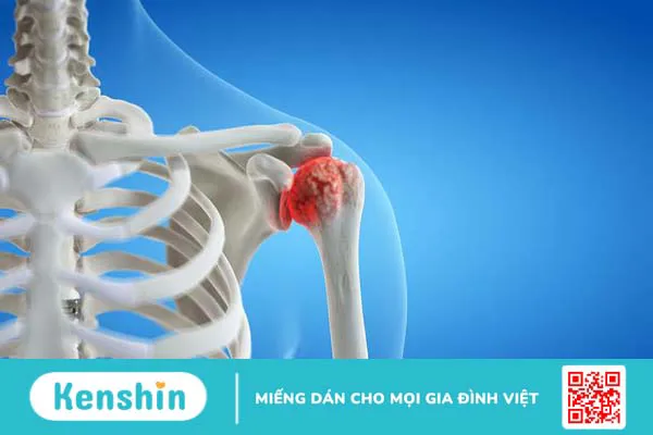 Phương pháp Đông y châm cứu viêm quanh khớp vai 1