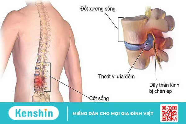 Phương pháp mổ vi phẫu thoát vị đĩa đệm có những ưu điểm gì 1