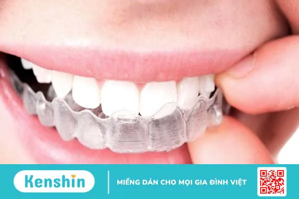 Phương pháp niềng răng tháo lắp là gì? Niềng răng tháo lắp có thật sự hiệu quả không?