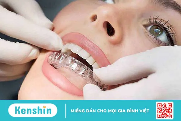 Phương pháp niềng răng tháo lắp là gì? Niềng răng tháo lắp có thật sự hiệu quả không? 3