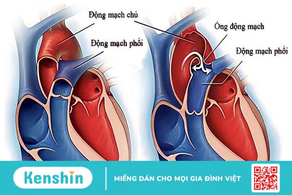 Phương pháp phẫu thuật điều trị tĩnh mạch phổi đổ lệch chỗ bán phần