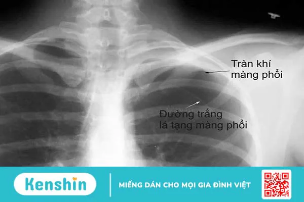 Phương pháp phẫu thuật điều trị tĩnh mạch phổi đổ lệch chỗ bán phần 4