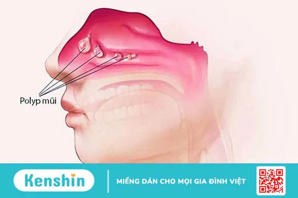 Polyp mũi có nguy hiểm không? Những điều cần biết về Polyp mũi