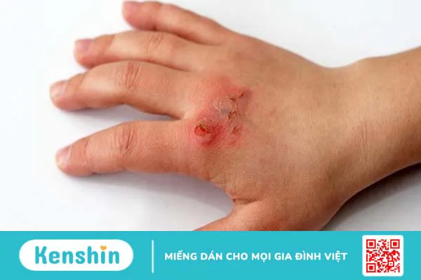 Quả mề gà là gì? Có tác dụng gì đối với sức khỏe? 4