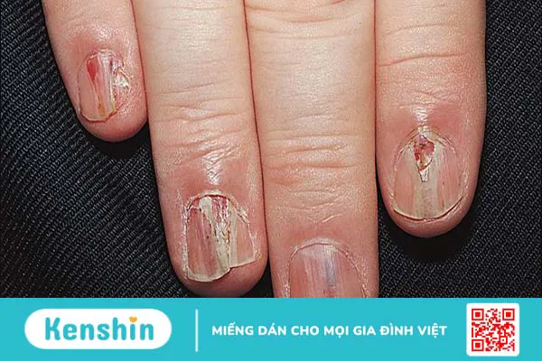 U cuộn mạch dưới móng - Quá trình phẫu thuật diễn ra như thế nào? 1