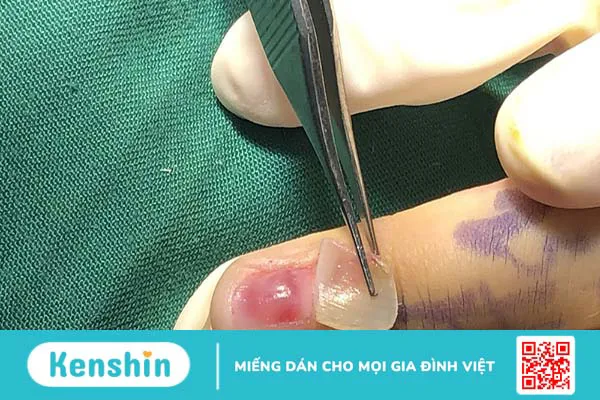 U cuộn mạch dưới móng - Quá trình phẫu thuật diễn ra như thế nào? 2